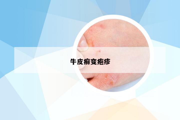 牛皮癣变疱疹