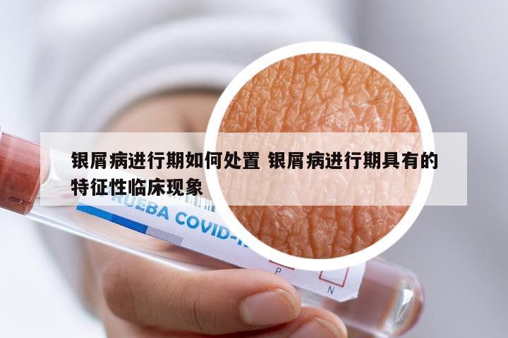 银屑病进行期如何处置 银屑病进行期具有的特征性临床现象