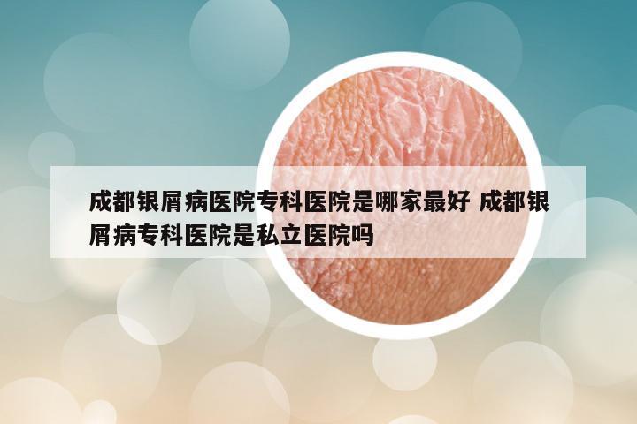 成都银屑病医院专科医院是哪家最好 成都银屑病专科医院是私立医院吗