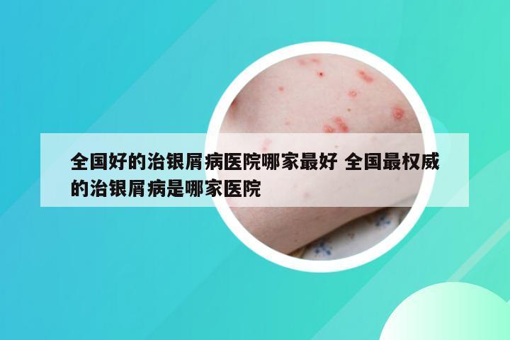 全国好的治银屑病医院哪家最好 全国最权威的治银屑病是哪家医院
