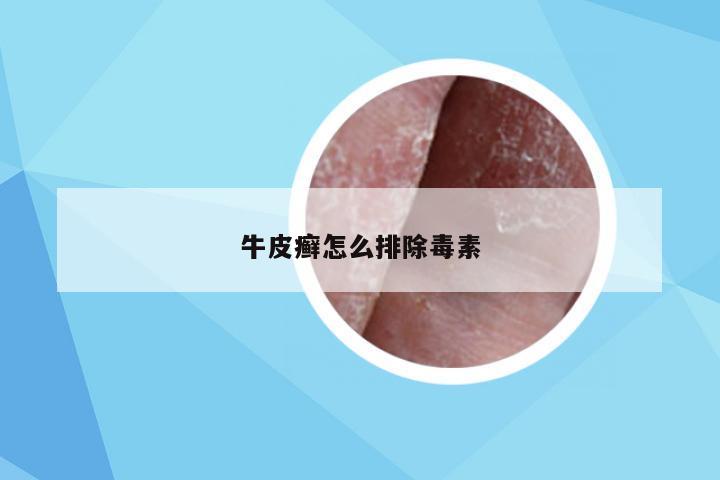 牛皮癣怎么排除毒素