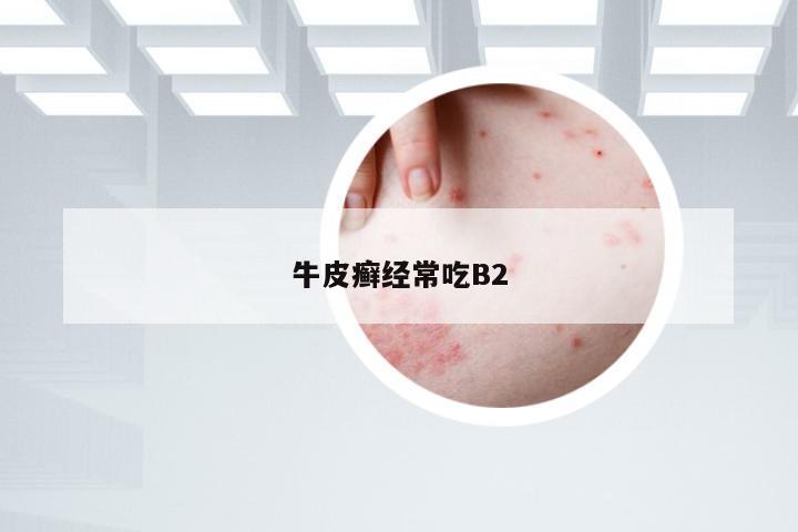 牛皮癣经常吃B2