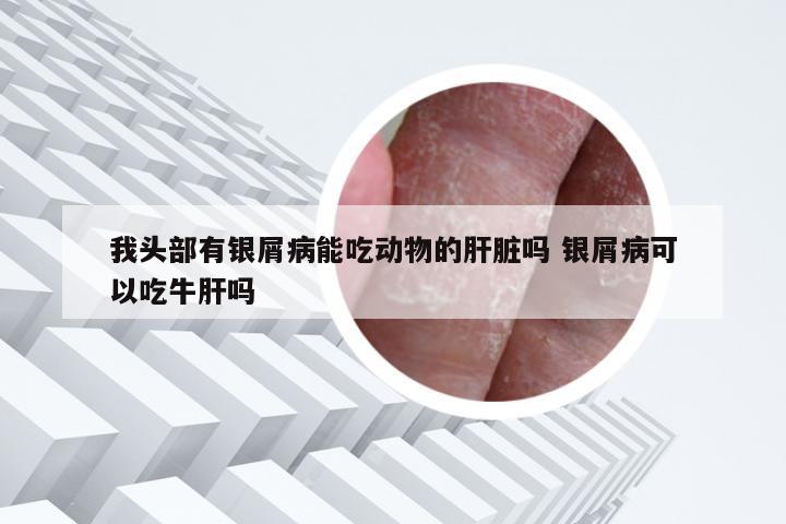 我头部有银屑病能吃动物的肝脏吗 银屑病可以吃牛肝吗