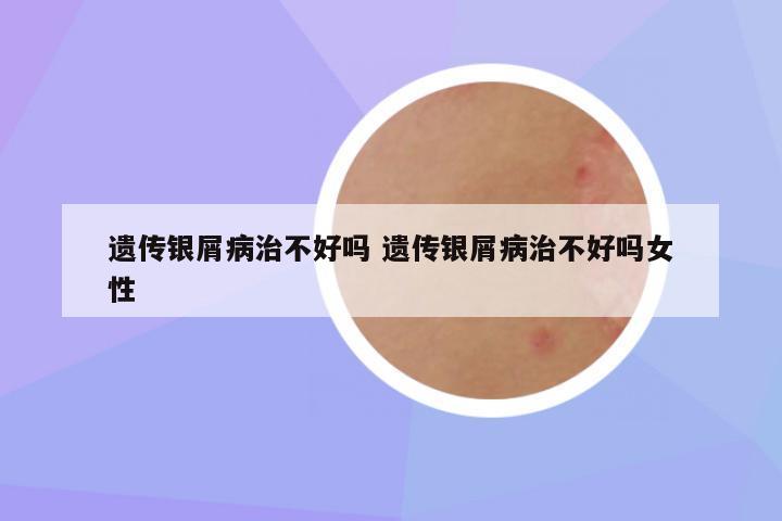 遗传银屑病治不好吗 遗传银屑病治不好吗女性