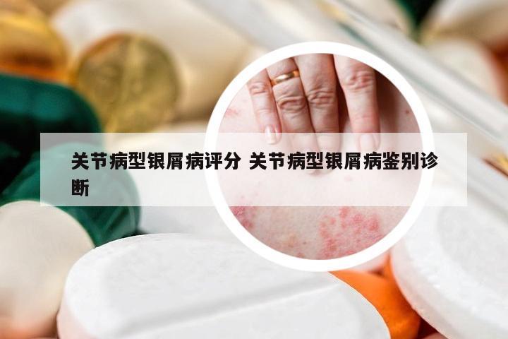 关节病型银屑病评分 关节病型银屑病鉴别诊断