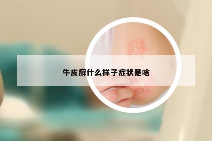牛皮癣什么样子症状是啥