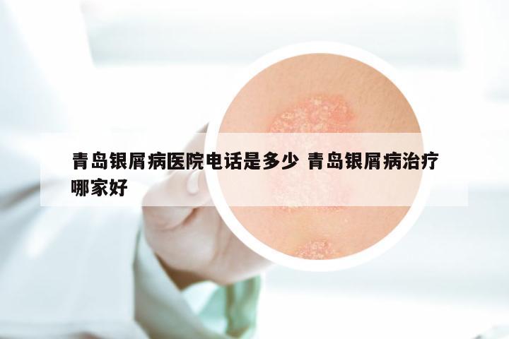 青岛银屑病医院电话是多少 青岛银屑病治疗哪家好