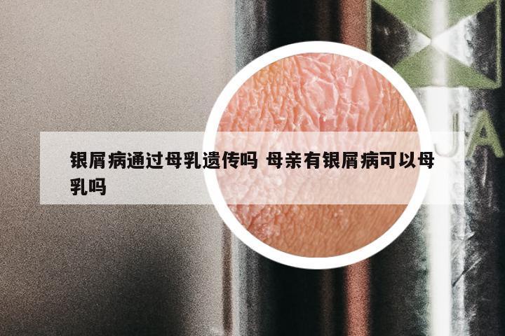 银屑病通过母乳遗传吗 母亲有银屑病可以母乳吗