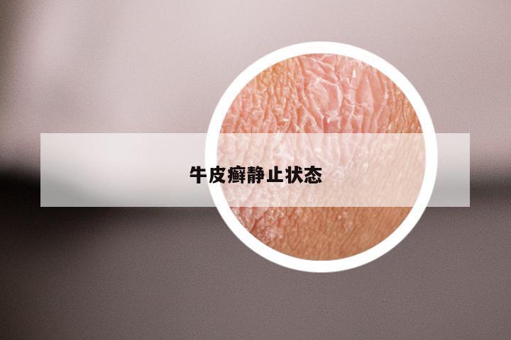牛皮癣静止状态