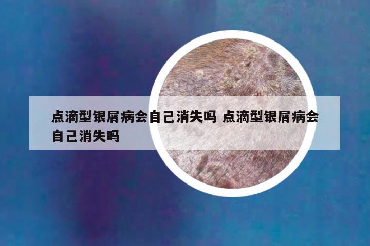 点滴型银屑病会自己消失吗 点滴型银屑病会自己消失吗