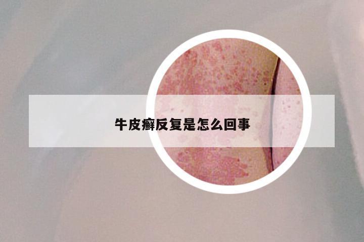 牛皮癣反复是怎么回事