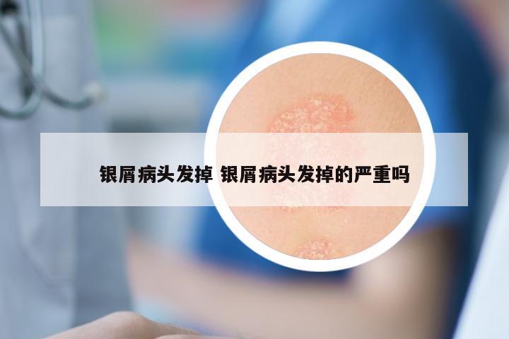 银屑病头发掉 银屑病头发掉的严重吗