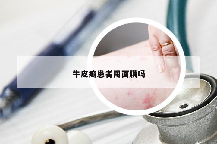 牛皮癣患者用面膜吗