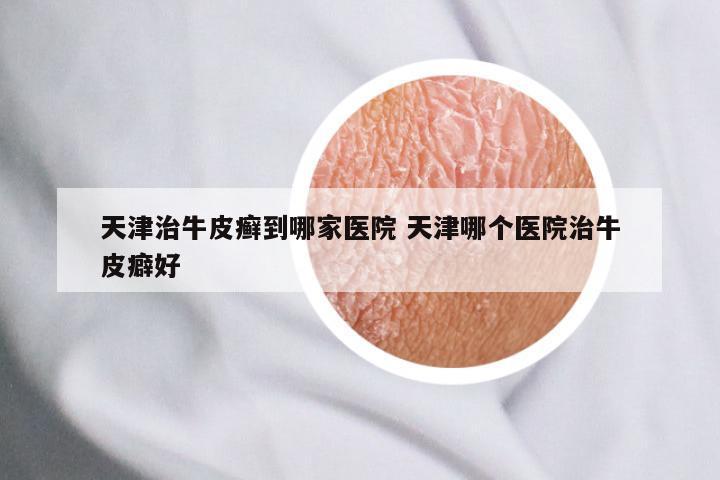 天津治牛皮癣到哪家医院 天津哪个医院治牛皮癖好