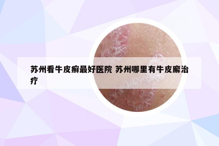 苏州看牛皮癣最好医院 苏州哪里有牛皮廨治疗