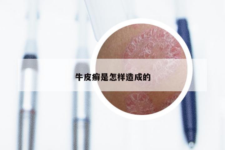 牛皮癣是怎样造成的