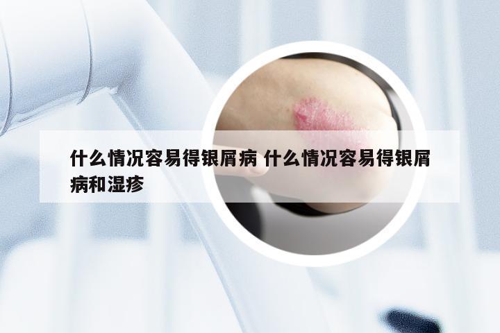 什么情况容易得银屑病 什么情况容易得银屑病和湿疹