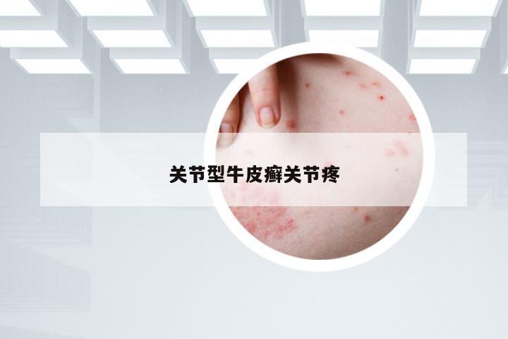关节型牛皮癣关节疼