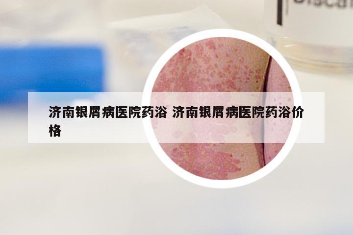 济南银屑病医院药浴 济南银屑病医院药浴价格
