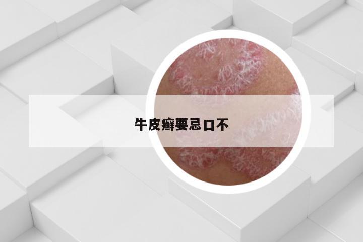 牛皮癣要忌口不