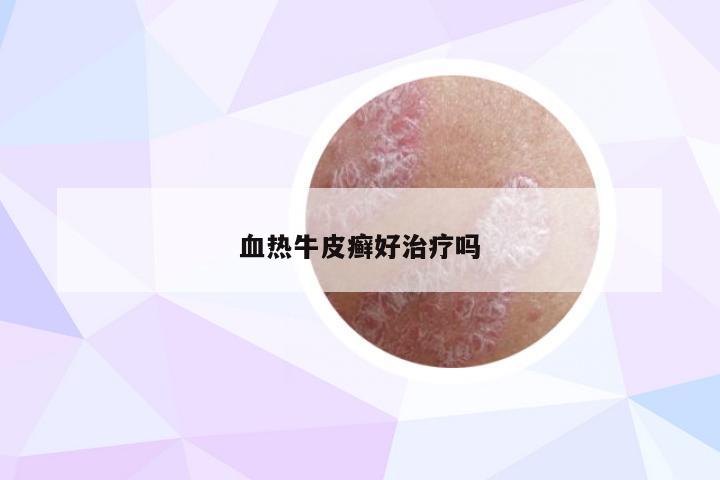 血热牛皮癣好治疗吗