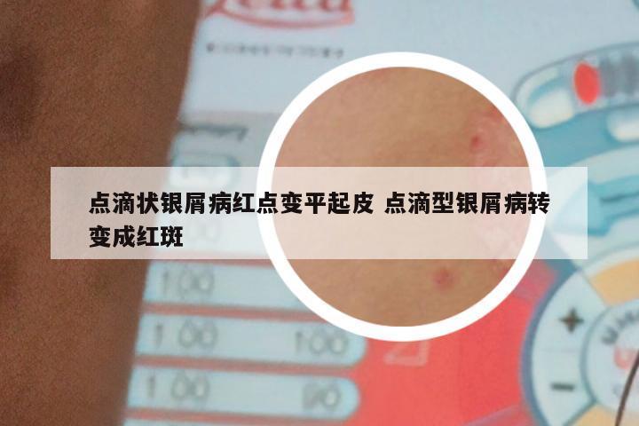 点滴状银屑病红点变平起皮 点滴型银屑病转变成红斑