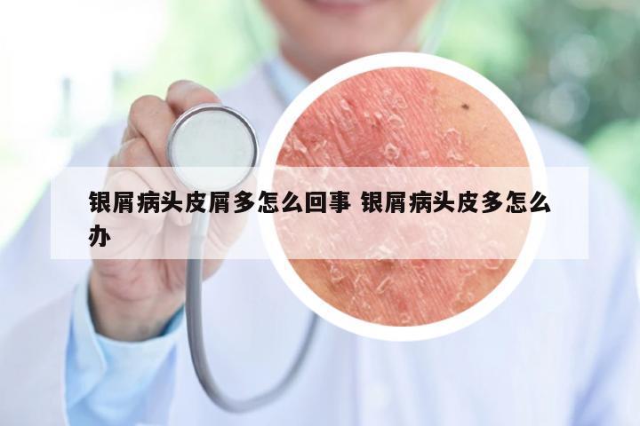 银屑病头皮屑多怎么回事 银屑病头皮多怎么办