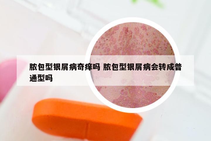 脓包型银屑病奇痒吗 脓包型银屑病会转成普通型吗