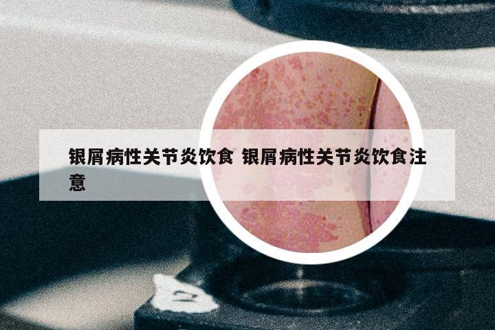 银屑病性关节炎饮食 银屑病性关节炎饮食注意