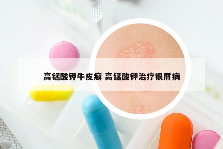 高锰酸钾牛皮癣 高锰酸钾治疗银屑病