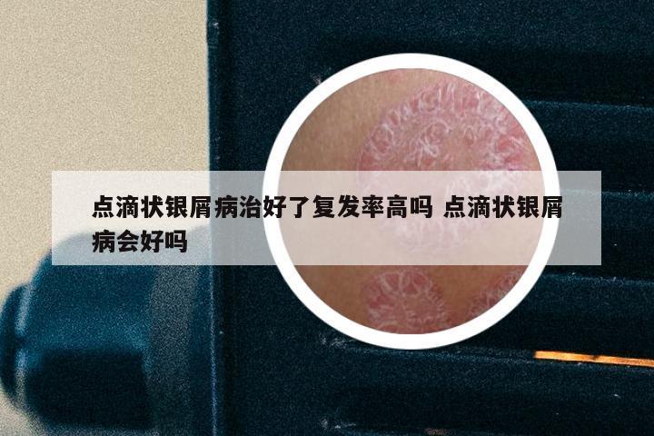 点滴状银屑病治好了复发率高吗 点滴状银屑病会好吗