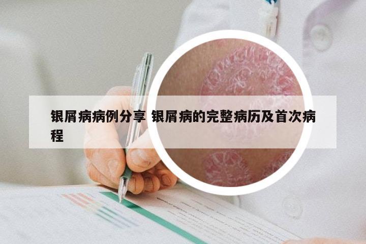 银屑病病例分享 银屑病的完整病历及首次病程