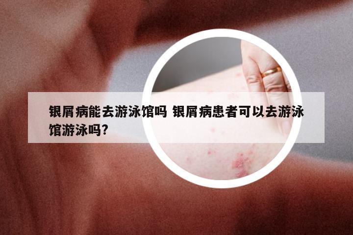银屑病能去游泳馆吗 银屑病患者可以去游泳馆游泳吗?