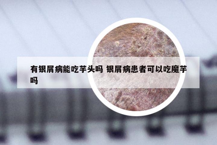有银屑病能吃芋头吗 银屑病患者可以吃魔芋吗