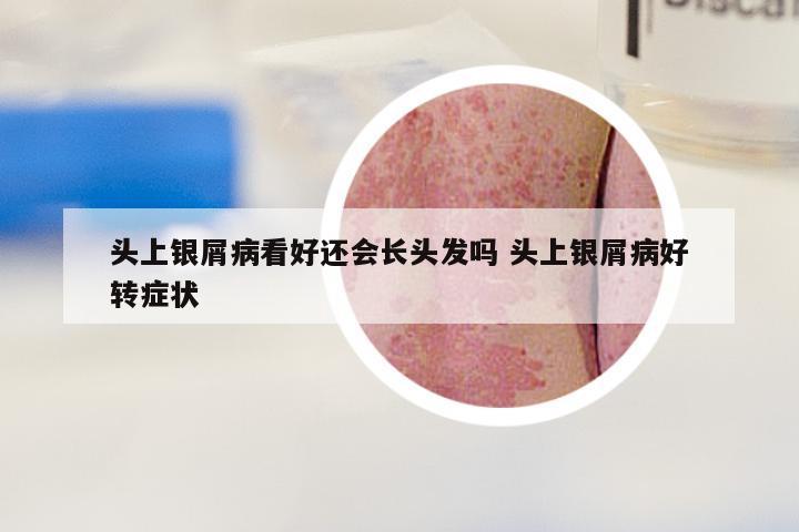 头上银屑病看好还会长头发吗 头上银屑病好转症状