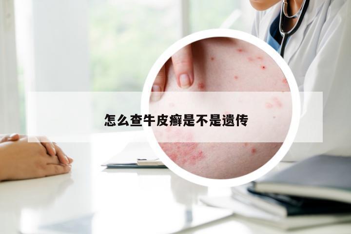怎么查牛皮癣是不是遗传