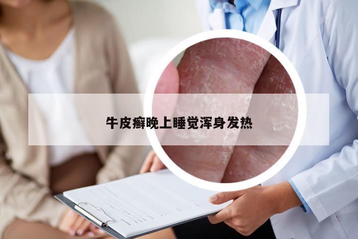 牛皮癣晚上睡觉浑身发热
