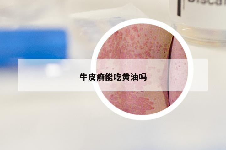 牛皮癣能吃黄油吗