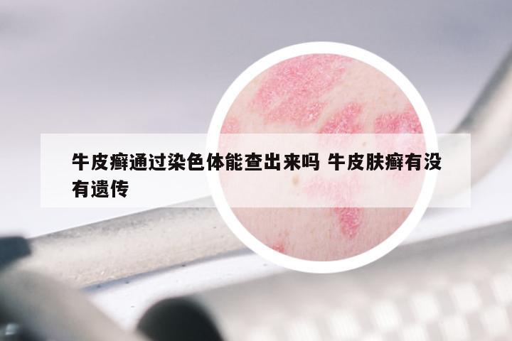 牛皮癣通过染色体能查出来吗 牛皮肤癣有没有遗传