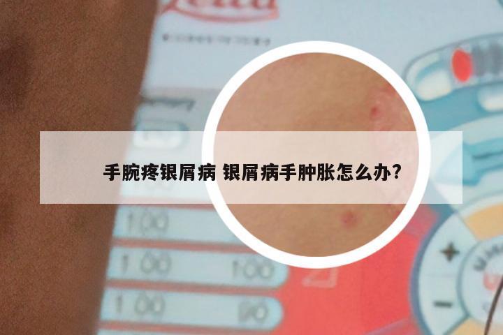 手腕疼银屑病 银屑病手肿胀怎么办?