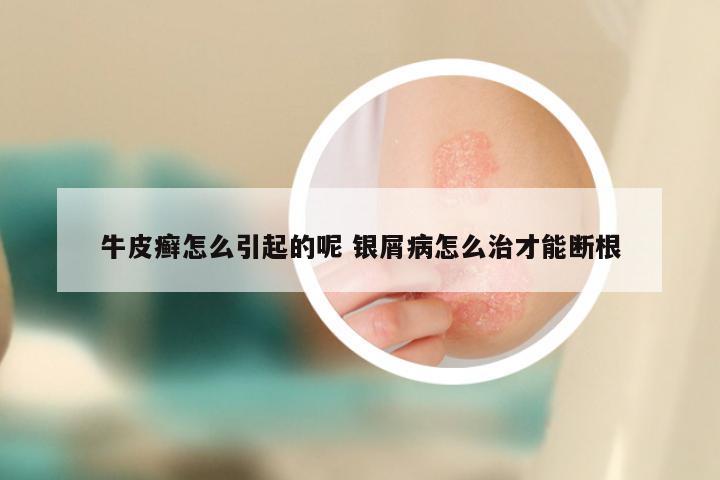 牛皮癣怎么引起的呢 银屑病怎么治才能断根