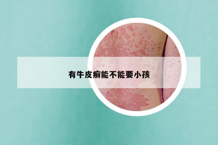 有牛皮癣能不能要小孩
