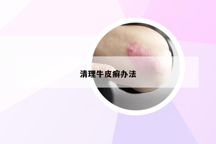 清理牛皮癣办法
