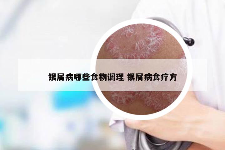 银屑病哪些食物调理 银屑病食疗方