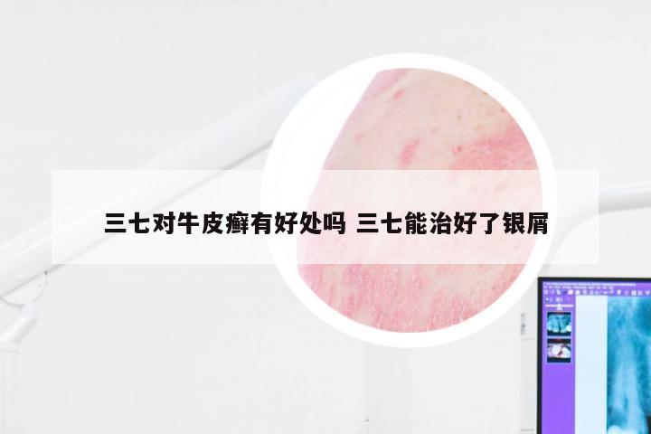 三七对牛皮癣有好处吗 三七能治好了银屑