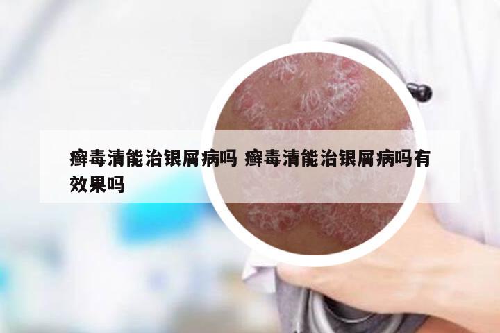 癣毒清能治银屑病吗 癣毒清能治银屑病吗有效果吗