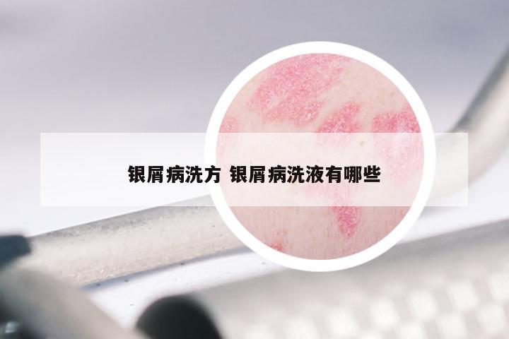 银屑病洗方 银屑病洗液有哪些