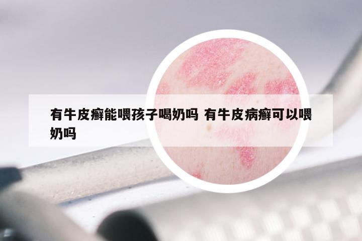有牛皮癣能喂孩子喝奶吗 有牛皮病癣可以喂奶吗