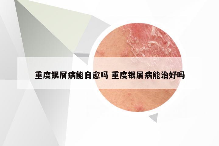 重度银屑病能自愈吗 重度银屑病能治好吗