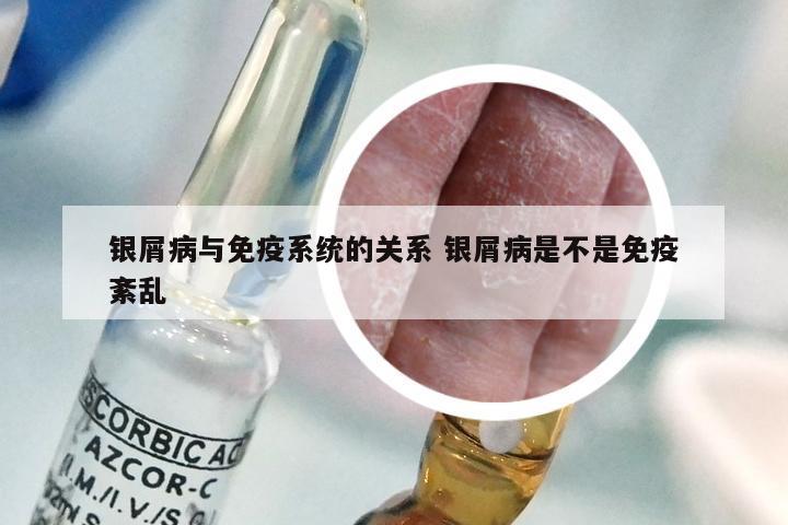 银屑病与免疫系统的关系 银屑病是不是免疫紊乱